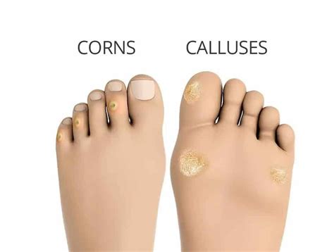 What is Corns and Calluses: Types, Symptoms, and Causes ...