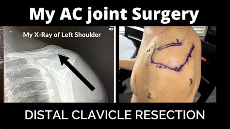 What to expect from a distal clavicle resection surgery | AC joint ...