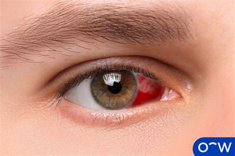 Eye Bleeding (Hyphema): Definition, Causes, Symptoms, Risk Factor and ...