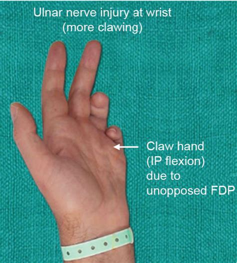 Ulnar Nerve Clawing