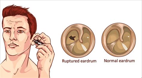 Healing Ruptured Eardrum