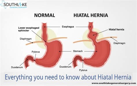 Hiatal Hernia Laparoscopic Surgery- Southlake General Surgery- Texas