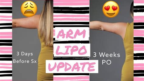 ARM LIPO 6 week update | Surgery Vlog | BBL surgery vlog - YouTube ...