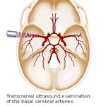 Desonics, Inc. – Transcranial Doppler Testing