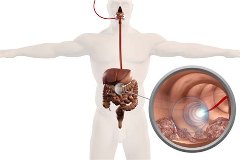 Endoscopic Ultrasound | GlobeHealer