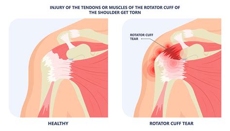 Rotator Cuff Injury: 7 Signs and Effective Care | Vejthani