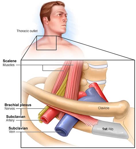 Thoracic outlet syndrome causes, symptoms, diagnosis, exercise & treatment