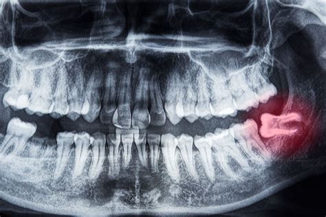 Look How Do Impacted Wisdom Teeth