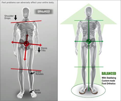 Are Your Pronated Feet (Flat Feet) Causing Your Low Back Pain ...