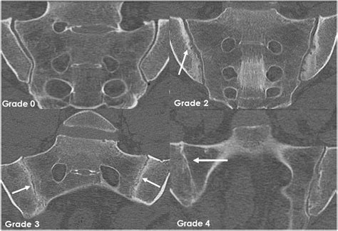 Sacroiliac Joint Erosion