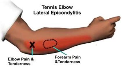 Elbow and wrist pain - How Physio Treatment helps | Adelaide