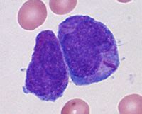 Acute Lymphoblastic Leukemia - Causes, Risk Factors, Symptoms ...