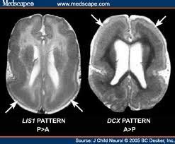 ourLilyTree: Lissencephaly