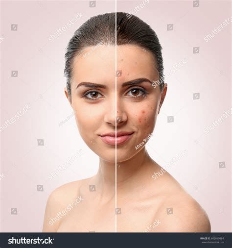 Woman Face Before After Acne Treatment Stock Photo 603810884 | Shutterstock