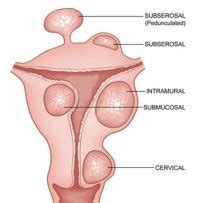 Top Ten Fibroid Facts