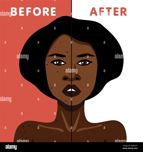 Vector image of an African American woman before and after acne skin ...