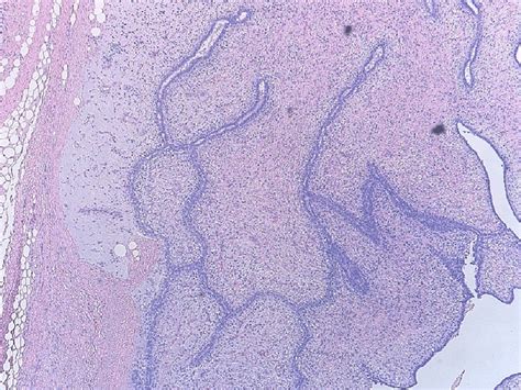 Histology with hematoxylin and eosin (4×) of the mastectomy specimen ...