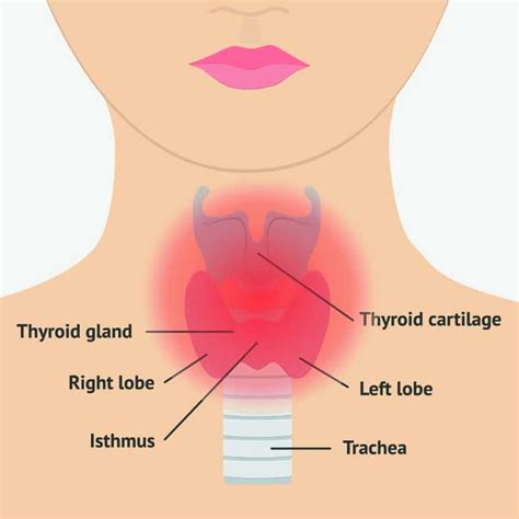 Thyroid Swelling (Goitre) - The ENT Clinic