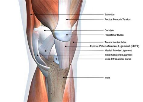 Medial Patellofemoral Ligament Injury | MPFL Tear | MPFL Insufficiency ...