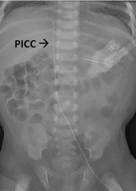 Femoral vein triple lumen catheter placement - terytruck