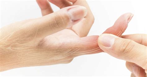 Sprained finger: Symptoms, treatment, and recovery