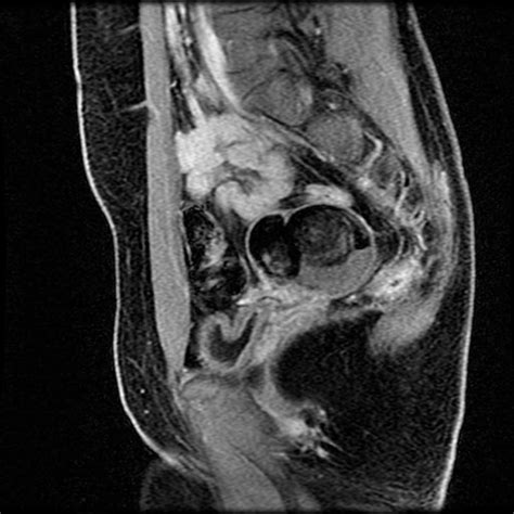 Ovarian dermoid - Body MR Case Studies - CTisus CT Scanning