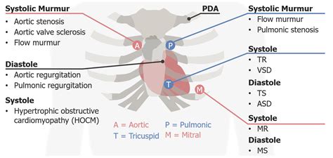 Mitral Insufficiency Murmur Sound