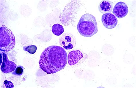 bone marrow smear, promyelocyte and erythroblasts | Hematology ...