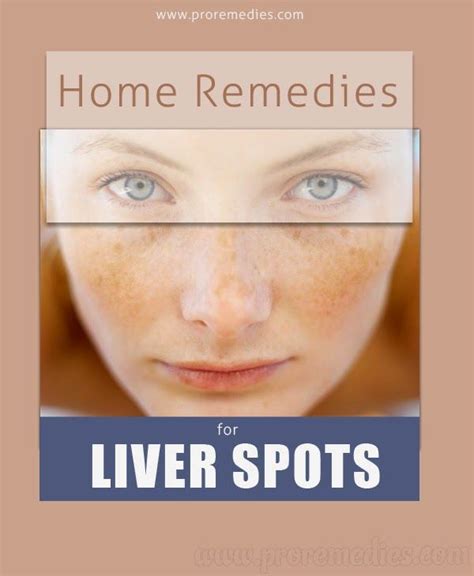 Home Remedies For Liver Spots | Home remedies, Remedies, Health and ...