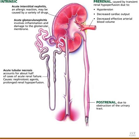 Figure 1 from Acute renal failure in hospitalized patients. | Semantic ...