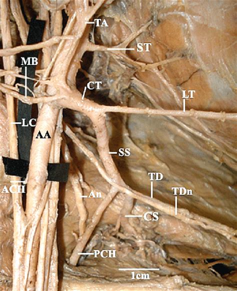 Subscapular Artery Cadaver