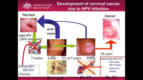 Cervical Cancer Screening. Is this the end of the pap smear? - YouTube