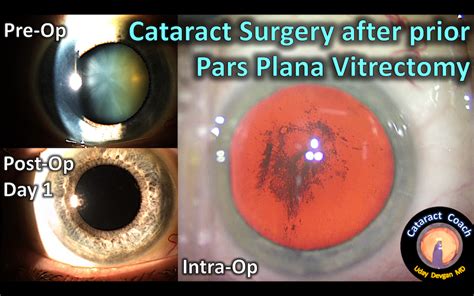 Cataract Surgery after Pars Plana Vitrectomy – Cataract Coach™