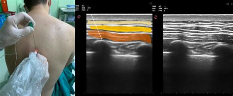 Patient position and sonoanatomy of the erector spinae plane block ...