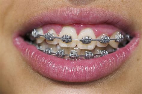 Braces (Teeth Straightening) – Ideal Dental Care – Even28: Dentist ...