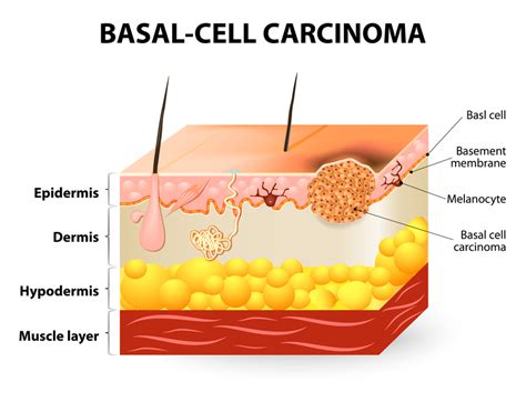 Basal Cell Carcinoma Symptoms - University Health News