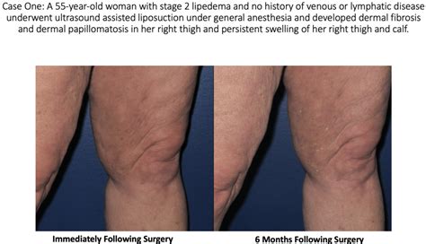 » Lymphatic Injury After Liposuction - Lipedema