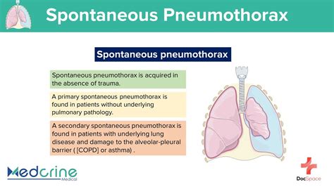 Spontaneous Pneumothorax: Causes, Clinical features, Pathophysiology ...