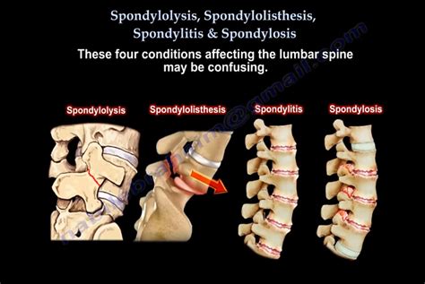 Spondylolysis, Spondylolisthesis, Spondylitis & Spondylosis: Conditions ...