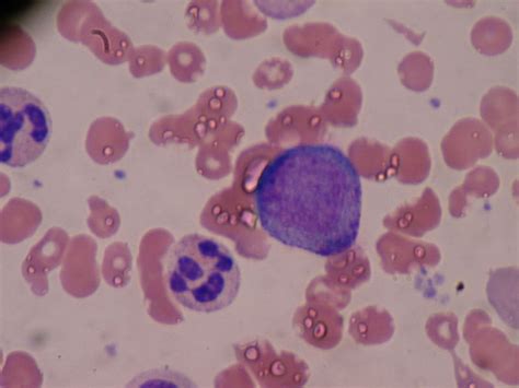 Difference Between Promyelocyte and Myelocyte | Compare the Difference ...