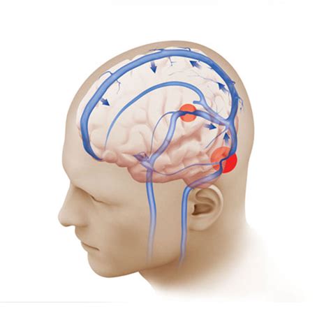 What Causes Pulsatile Tinnitus? | Neurological Surgery