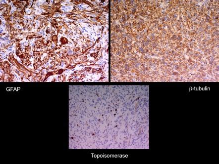 Pleomorphic xanthoastrocytoma | Image | Radiopaedia.org