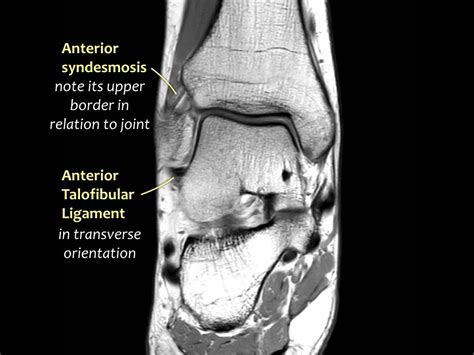 Ankle Mri Anatomy