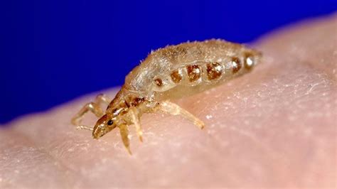 Images Of Lice Bites On Scalp : The more time you spend with. - Gezegen ...