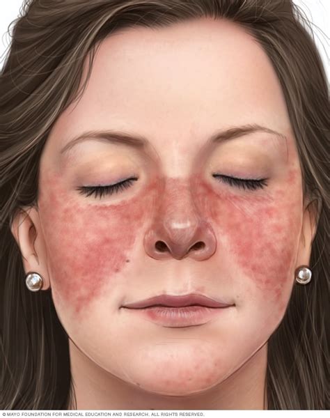 Lupus facial rash - Mayo Clinic