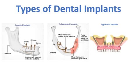 What Different Types of Dental Implant Options Do You Have? | Advanced ...