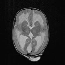 Lissencephaly - Physiopedia