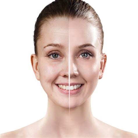 Woman`s Face before and after Rejuvenation. Stock Image - Image of acne ...