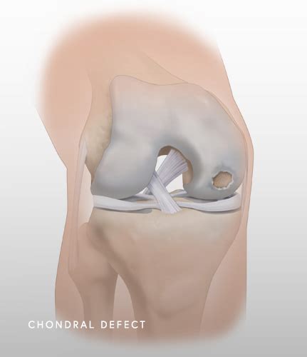 Chondral Defect Knee Chicago, IL | Dr. Jorge Chahla