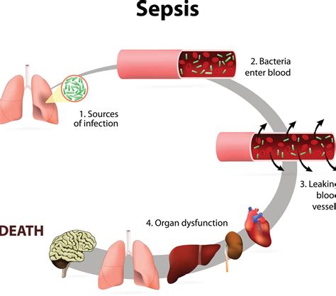 What EMS needs to know about new pediatric sepsis guidelines